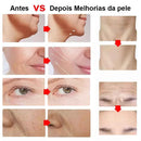 Mini Hifu Ultrassom Portátil Microfocado Para O Rosto - Vida Eficaz